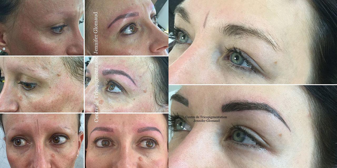 La dermopigmentation capillaire ou la micropigmentation de cheveux