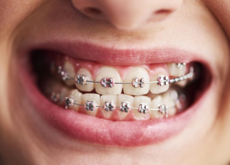 Différences entre broches et invisalign : quelle méthode choisir ?
