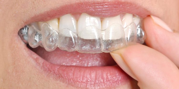 Différences entre broches et invisalign : quelle méthode choisir ?