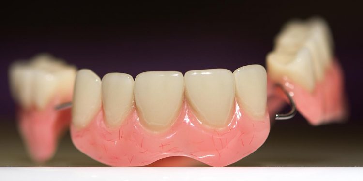 La prothèse dentaire amovible partielle